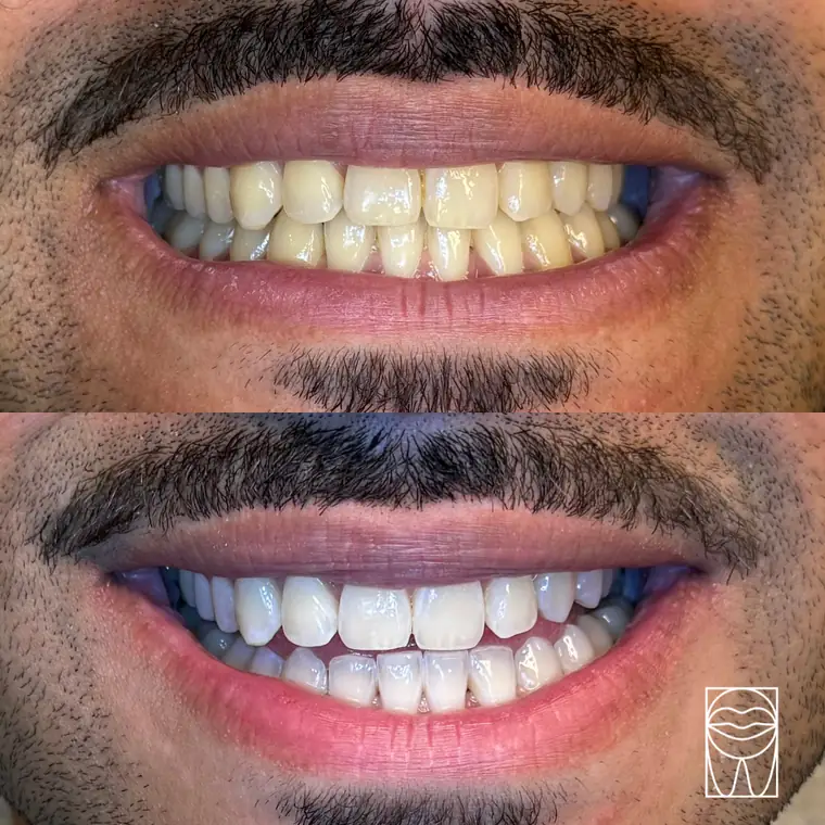 Avant et après : blanchiment — sourire complet