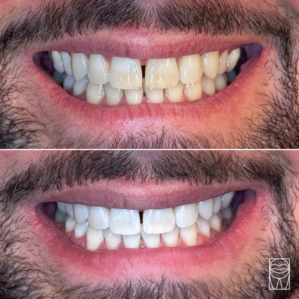 Blanchiment dentaire avant-après : transformation spectaculaire du sourire et résultat professionnel."