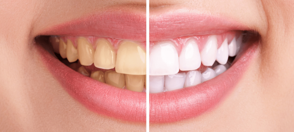 Blanchiment dentaire professionnel Paris Dental Studios