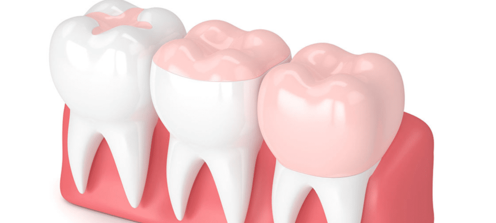 Composite esthétique dentiste