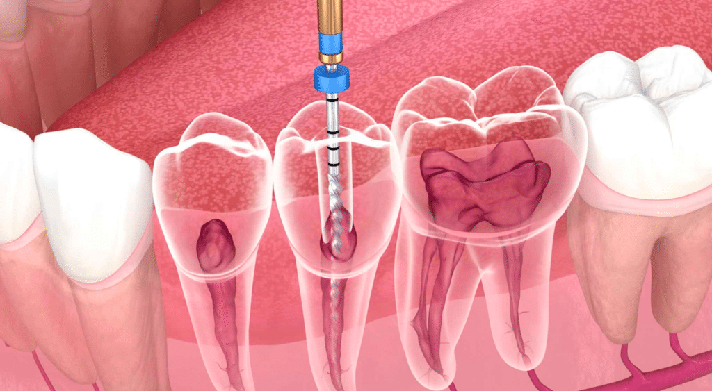 Endodontie : déroulement, prix, risques à éviter