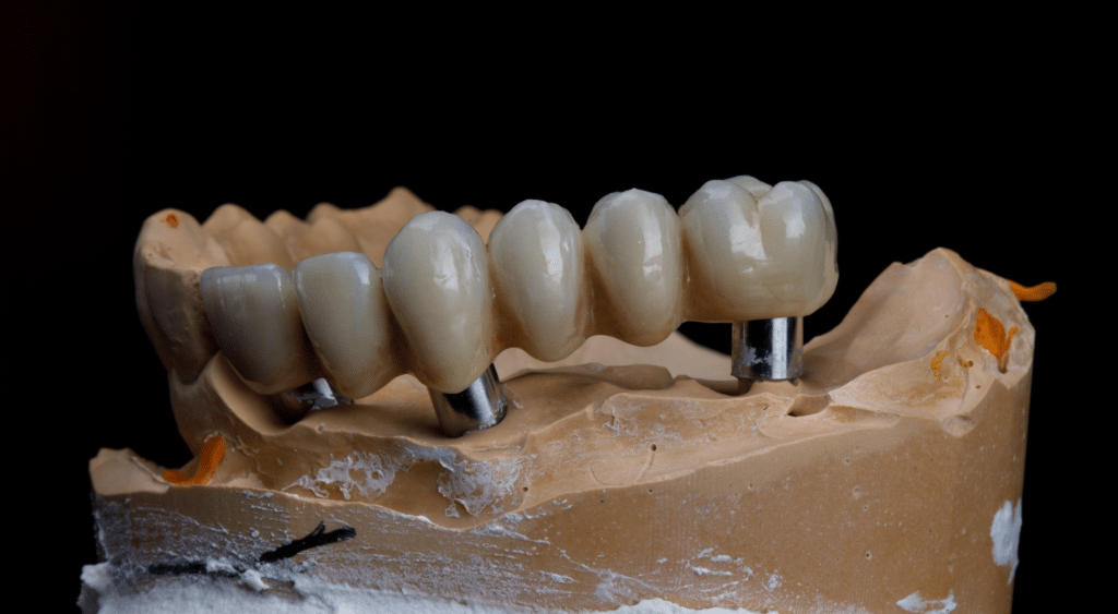 Bridge sur implants dentaires