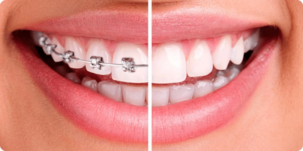 Gouttières invisibles vs bagues, quelle solution d’orthodontie choisir ?