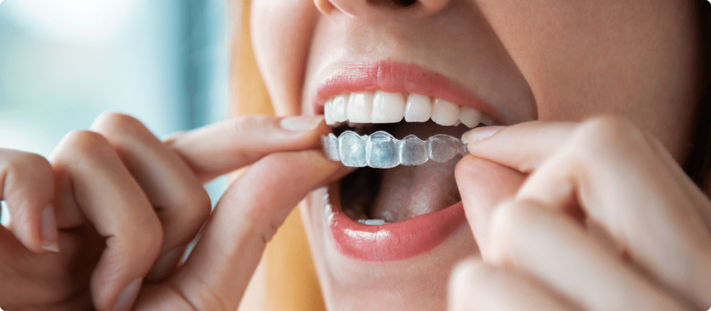 gouttières invisibles - orthodontie adulte
