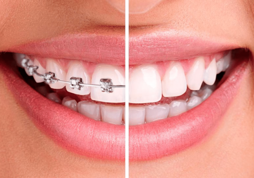 Gouttières invisibles ou bagues, quelle solution d’orthodontie choisir ?