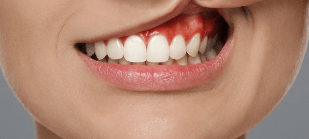 Soigner la parodontite Paris Dental Studios