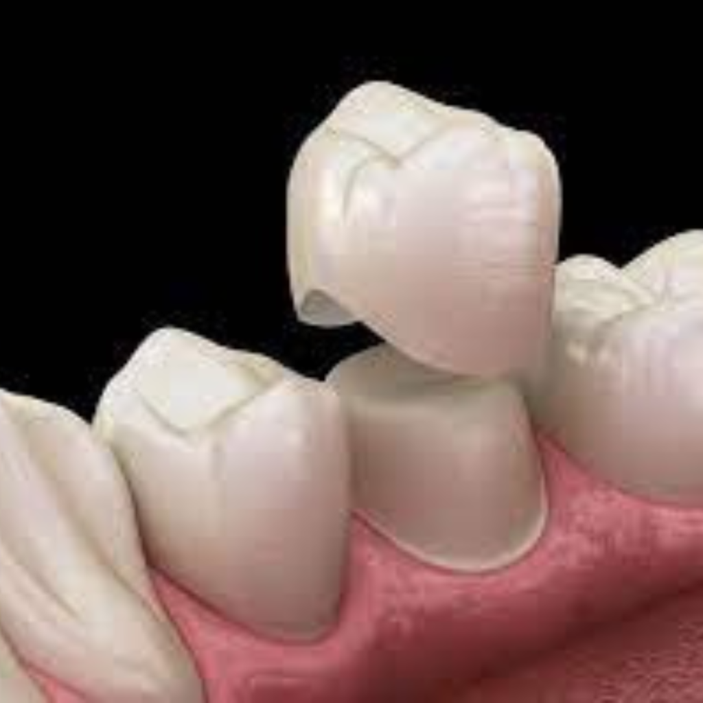 Couronne dentaire tombée : comment réagir rapidement ? Paris Dental Studio