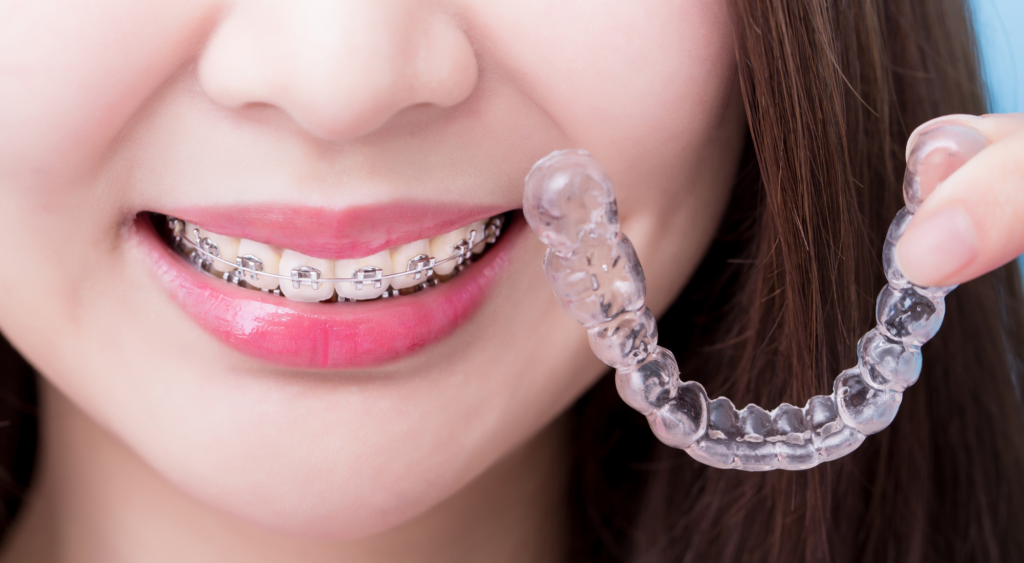 Les Alternatives aux Appareils Orthodontiques