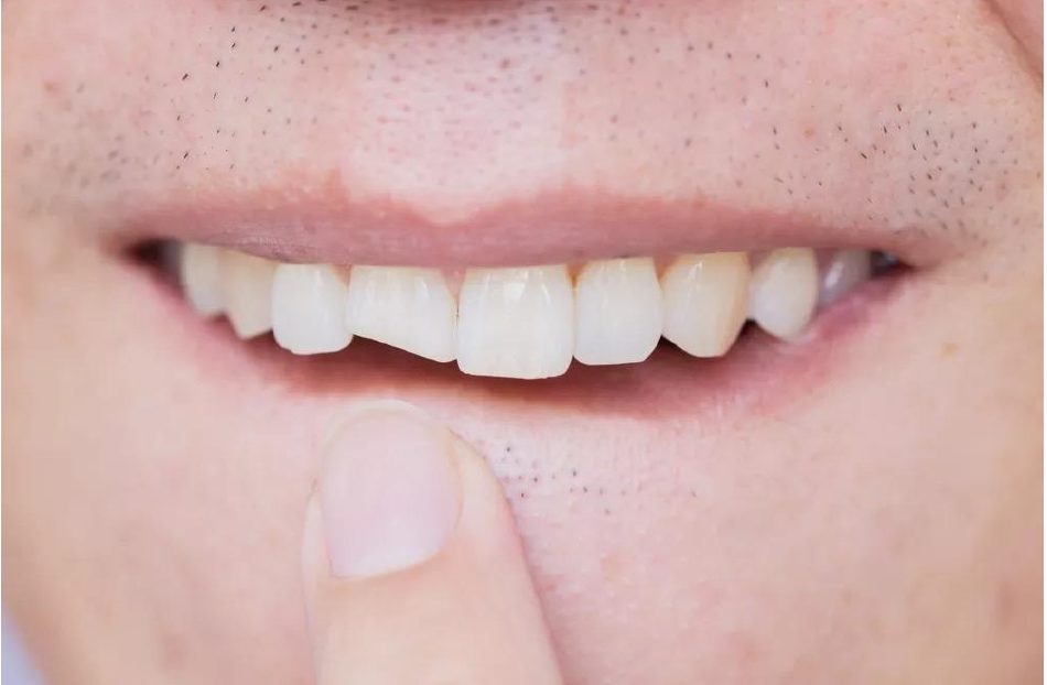 Dent cassée : que faire en urgence ?